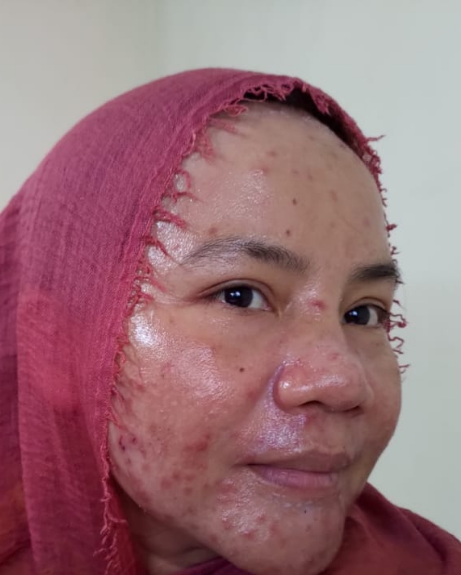 Foto kulit sebelum — 6 aug 2021