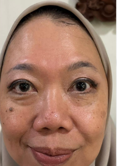 Foto kulit sebelum — feb 2025