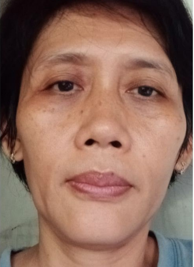 Foto kulit sebelum — usia 50