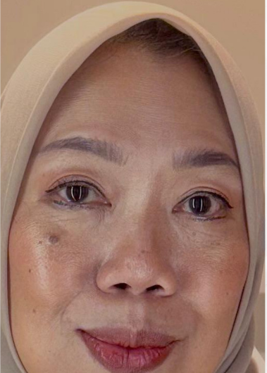 Foto kulit sesudah — aug 2025