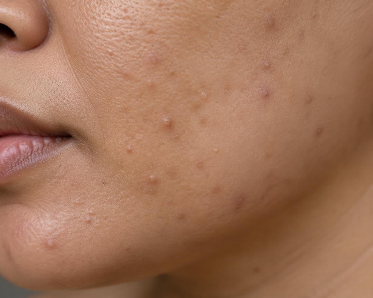 Close-up tekstur kulit untuk concern jerawat & pori
